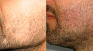 Beard Hair Transplant in Dubai: Step-by-Step Procedure Explained