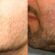 Beard Hair Transplant in Dubai: Step-by-Step Procedure Explained