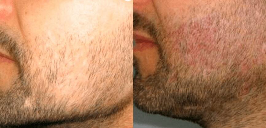 Beard Hair Transplant in Dubai: Step-by-Step Procedure Explained