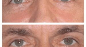 Laser Eye Bag Removal: The Best Doctors in Dubai Explain It