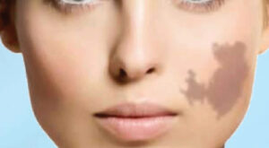 Birthmark Removal in Dubai: Expert-Backed Myths and Facts