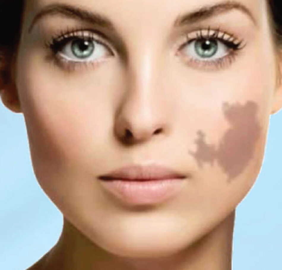 Birthmark Removal in Dubai: Expert-Backed Myths and Facts