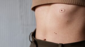 Birthmark Removal in Dubai: Expert-Backed Myths and Facts