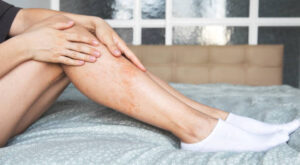 Birthmark Removal in Dubai: Vascular Mark Specialists