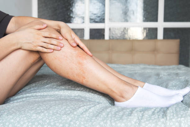 Birthmark Removal in Dubai: Vascular Mark Specialists