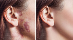 Best Ways for Birthmark Removal in Dubai