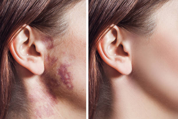 Best Ways for Birthmark Removal in Dubai