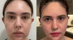 Jawline Contouring vs. Buccal Fat Removal: Advice from the Best Doctors in Dubai