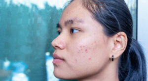 Can Laser Acne Scar Treatment in Abu Dhabi Fix Long-Term Damage?