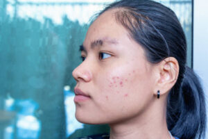 Can Laser Acne Scar Treatment in Abu Dhabi Fix Long-Term Damage?