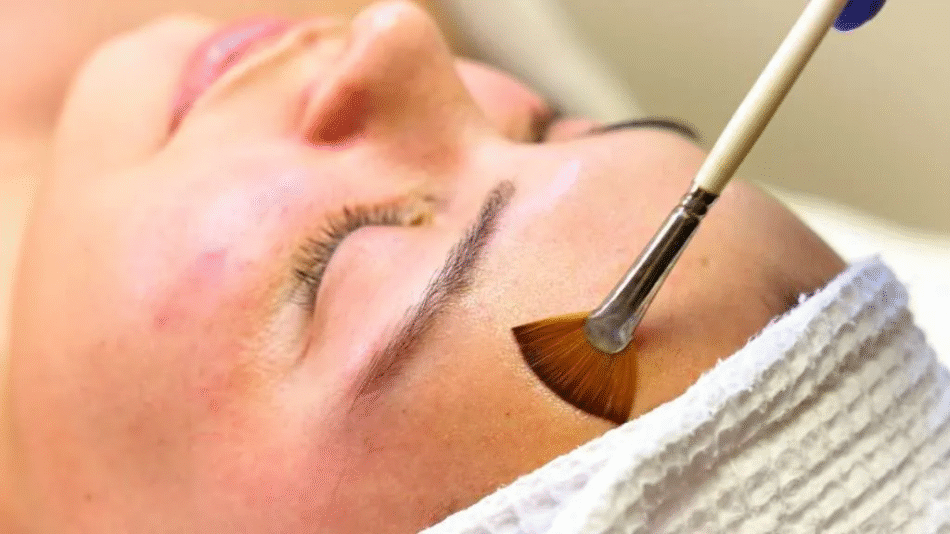 Cold Peel for Oily Skin: Tips and Benefits