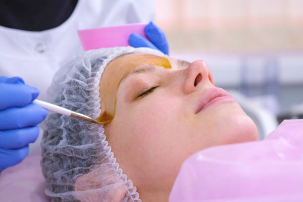 Everything You Need to Know About Advanced Chemical Peels in Dubai