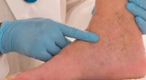 Chronic Venous Insufficiency and Social Security Disability Guide