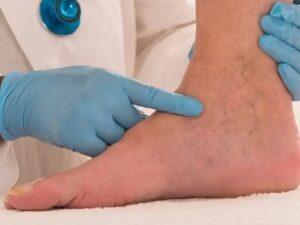 Chronic Venous Insufficiency and Social Security Disability Guide
