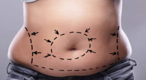 Circumferential Abdominoplasty Dubai: Sculpt Your Midsection