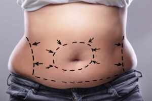Circumferential Abdominoplasty Dubai: Sculpt Your Midsection