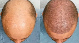 Hybrid Hair Transplant in Dubai: Restore Receding Hairlines