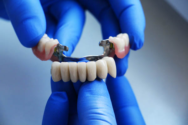 How to Extend the Life of Dental Crowns and Bridges