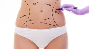 Does Liposuction Deliver the Shape People Expect?