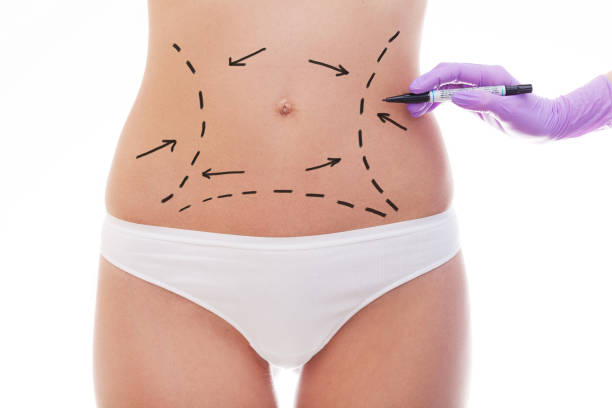 Does Liposuction Deliver the Shape People Expect?