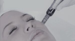 Dubai Dermapen Treatment for Soft Refreshed Skin