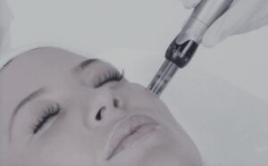 Dubai Dermapen Treatment for Soft Refreshed Skin