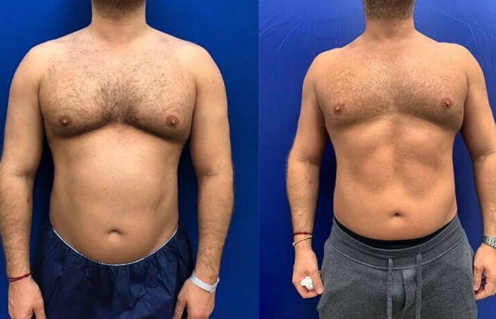 EMS Body Sculpting Pune for Men: A Quiet Transformation Powered by Technology, Discipline & Desire