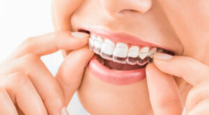 Why Glendale Invisalign Is Becoming the Top Choice for Modern Orthodontics
