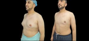 Gynaecomastia Surgery in Dubai: Ideal Candidates and Eligibility Checklist