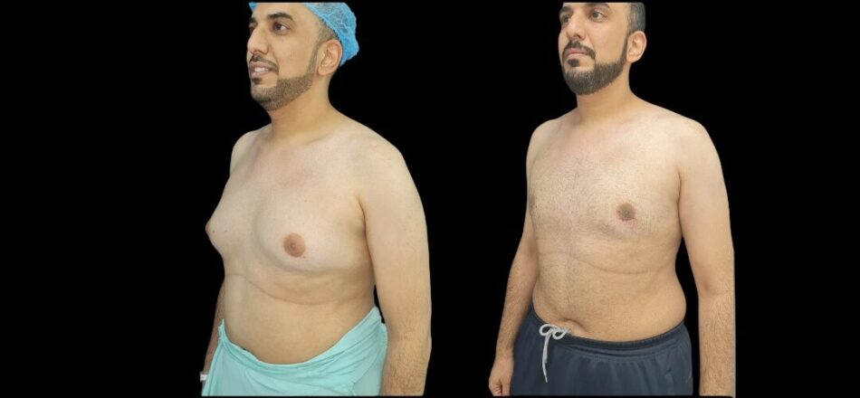 Gynaecomastia Surgery in Dubai: Ideal Candidates and Eligibility Checklist