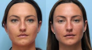 Thread Lift by Best Plastic Surgeon in Dubai: Rejuvenation Without Surgery