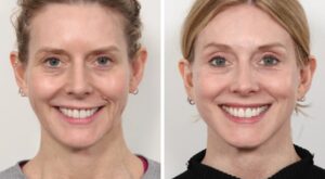 Best Plastic Surgeon in Dubai: Your Guide to Long-Lasting Thread Lift Results
