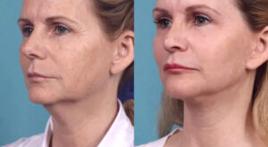How the Best Plastic Surgeon in Dubai Customizes Chemical Peels for Aging Skin