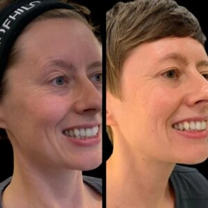 Start Your Skin Treatment with Best Doctors in dubai Profhilo