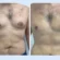 Understanding the Emotional Impact of Gynecomastia in Dubai