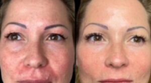 Elite Profhilo by the Best Plastic Surgeon in dubai Schedule