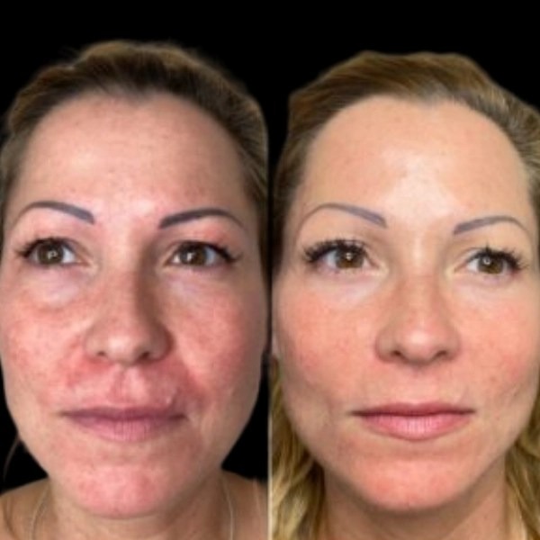 Elite Profhilo by the Best Plastic Surgeon in dubai Schedule