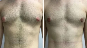 What First-Time Patients Can Expect From the Best Gynecomastia Surgeon in Dubai