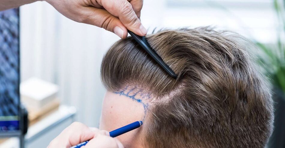 Hair Transplant in Sharjah: Cost and Options