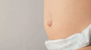 How Pain is Managed After Hernia Surgery