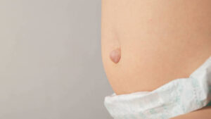 How Pain is Managed After Hernia Surgery