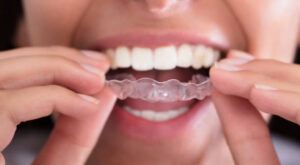 How Clear Aligners Help Build Confidence Gradually ?
