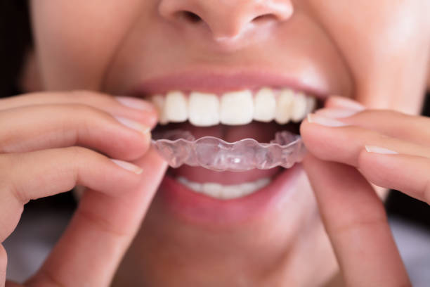 How Clear Aligners Help Build Confidence Gradually ?