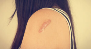 How Keloid Treatment Helps Restore Skin Texture ?