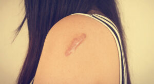 How Keloid Treatment Helps Restore Skin Texture ?