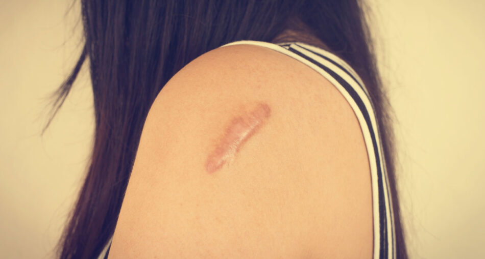 How Keloid Treatment Helps Restore Skin Texture ?