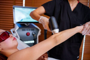 Laser Hair Removal for Stretch Mark Camouflage