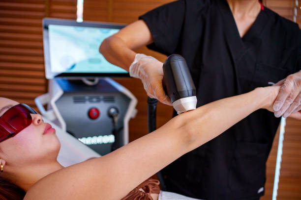 Laser Hair Removal for Stretch Mark Camouflage