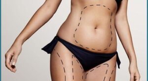 Advanced Laser Liposuction in Dubai: What Makes It So Popular?