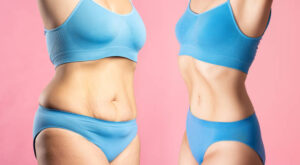 The Science Behind Liposuction and Fat Removal Explained